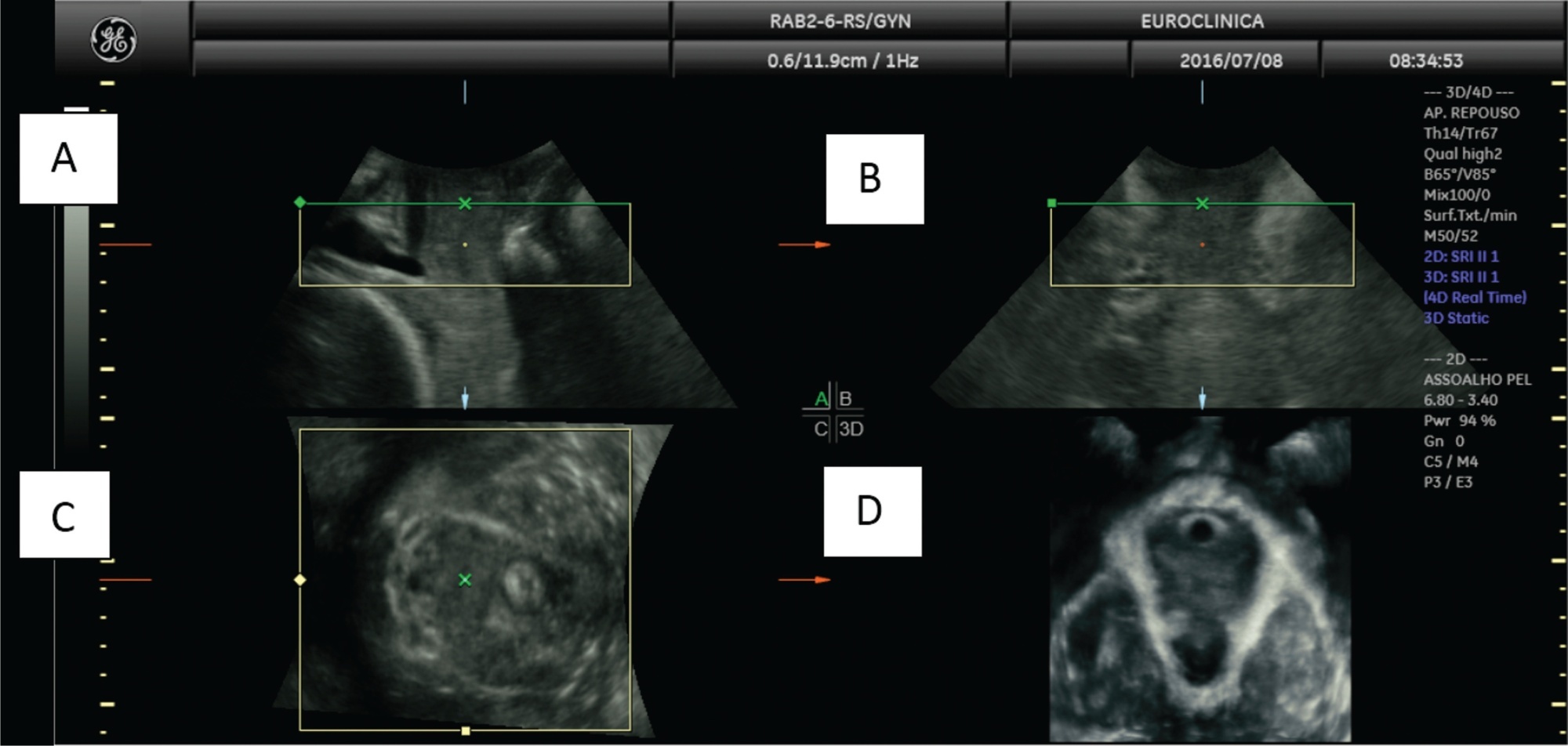 Assessment of Pelvic Floor Disorders due to the Gestational Diabetes Mellitus Using Three-Dimensional Ultrasonography: A Narrative Review
