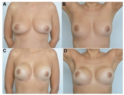 Salvage Nipple-sparing Mastectomy for Patients with Breast Cancer Recurrence: A Case Series of Brazilian Patients