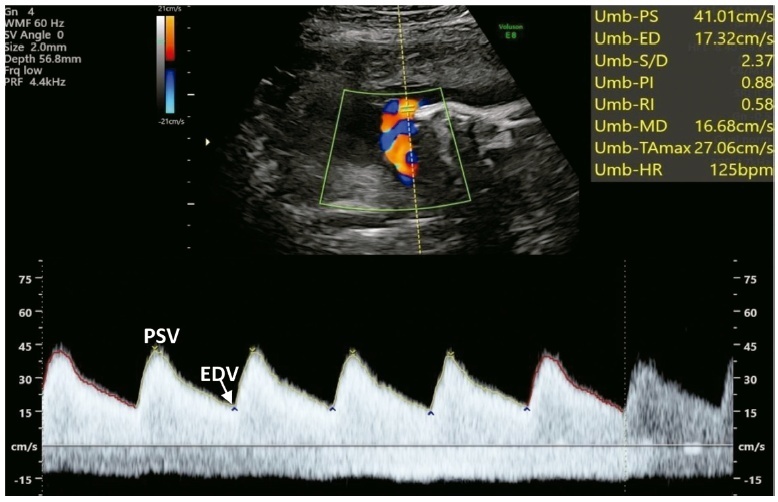 Doppler Ultrasound of the Umbilical Artery: Clinical Application