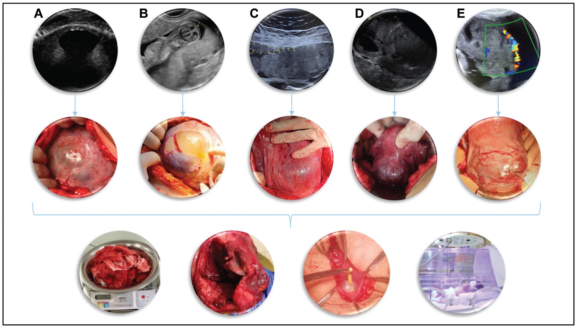 Placenta Accreta Spectrum Disorders: Current Recommendations from the Perspective of Antenatal Imaging