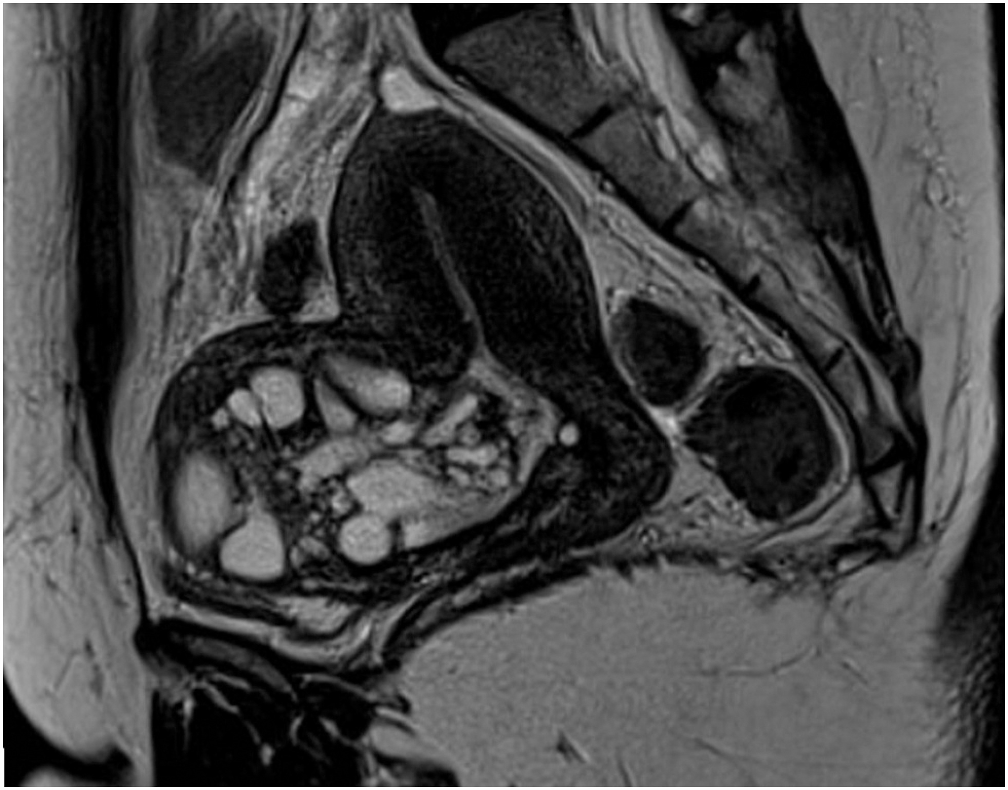 Mucinous Cystadenoma Arising in a Uterine Isthmocele: A Case Report