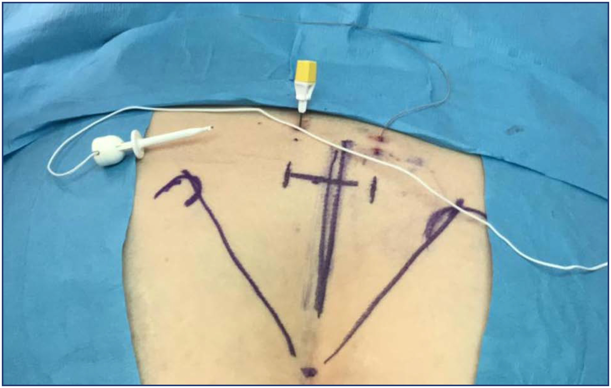 Nodular image in the appendix observed on ultrasound: endometriosis or neuroendocrine neoplasia?