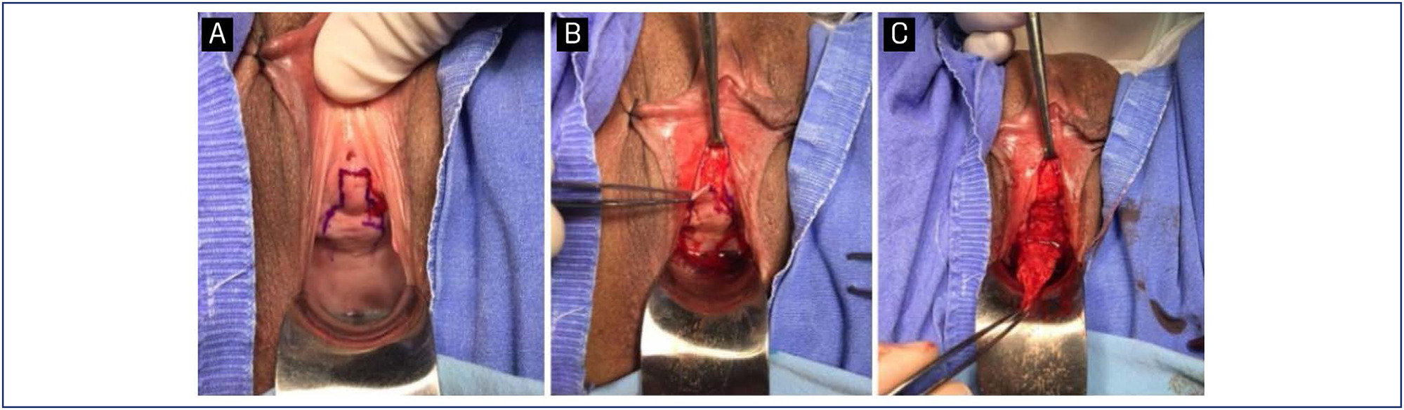 Outcomes of urethral meatal preservation ventral urethroplasty for female urethral stricture: a series of cases