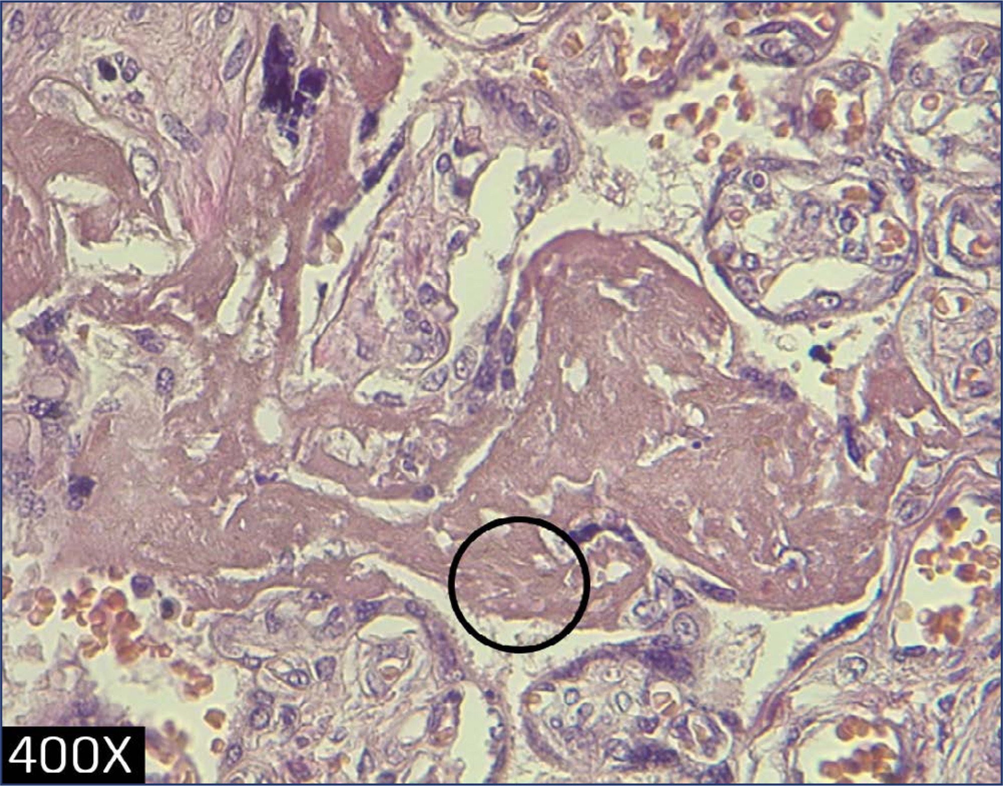 Association of placental histopathological findings with COVID-19 and its predictive factors