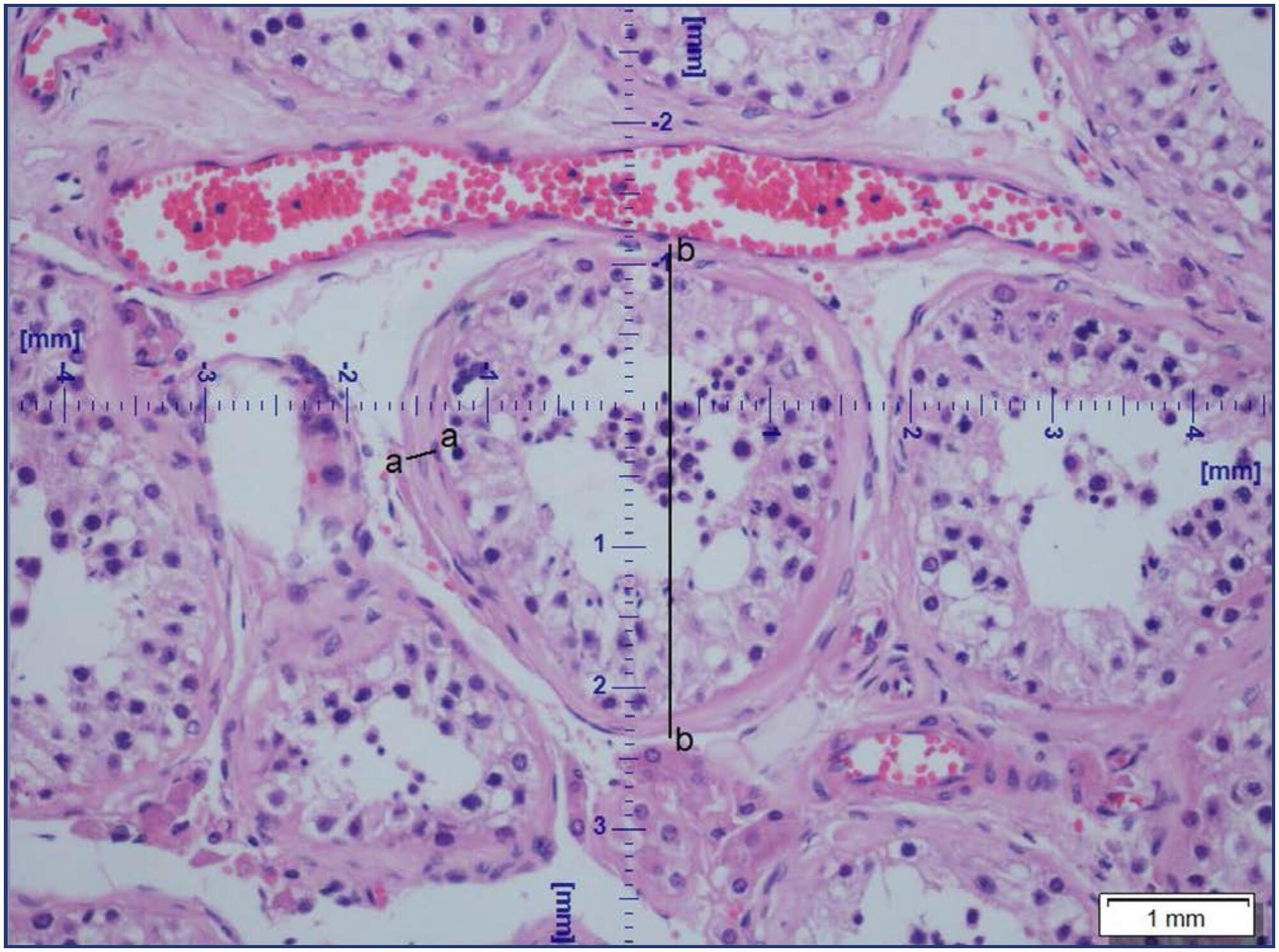 Gender affirming hormone therapy and transgender women fertility: Histologic predictors of germ cell presence