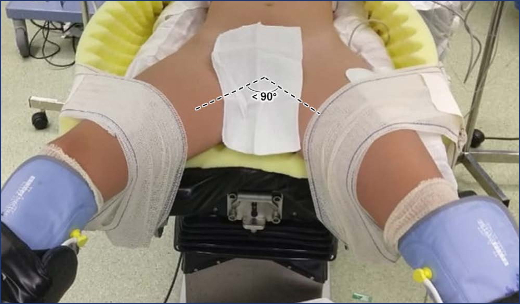 Patient positioning in minimally invasive gynecologic surgery: strategies to prevent injuries and improve outcomes