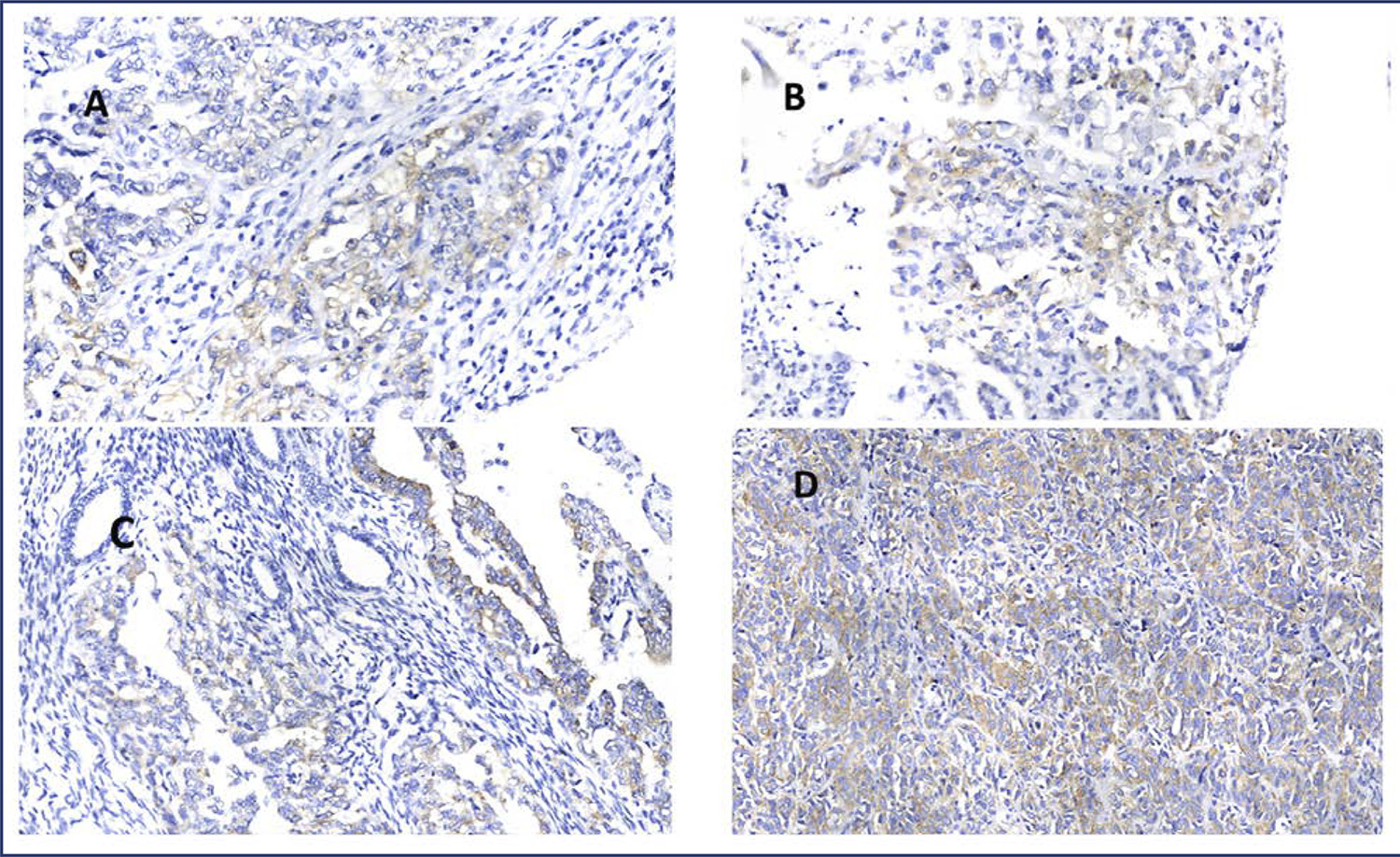 Association of insulin-like growth factor II mrna-binding protein 3 (IMP3) expression with prognostic and morphological factors in endometrial cancer