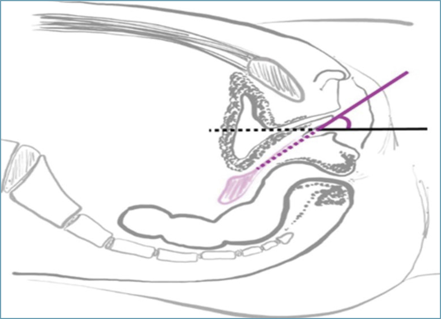 Mayer-Rokitansky-Kuster-Hauser syndrome