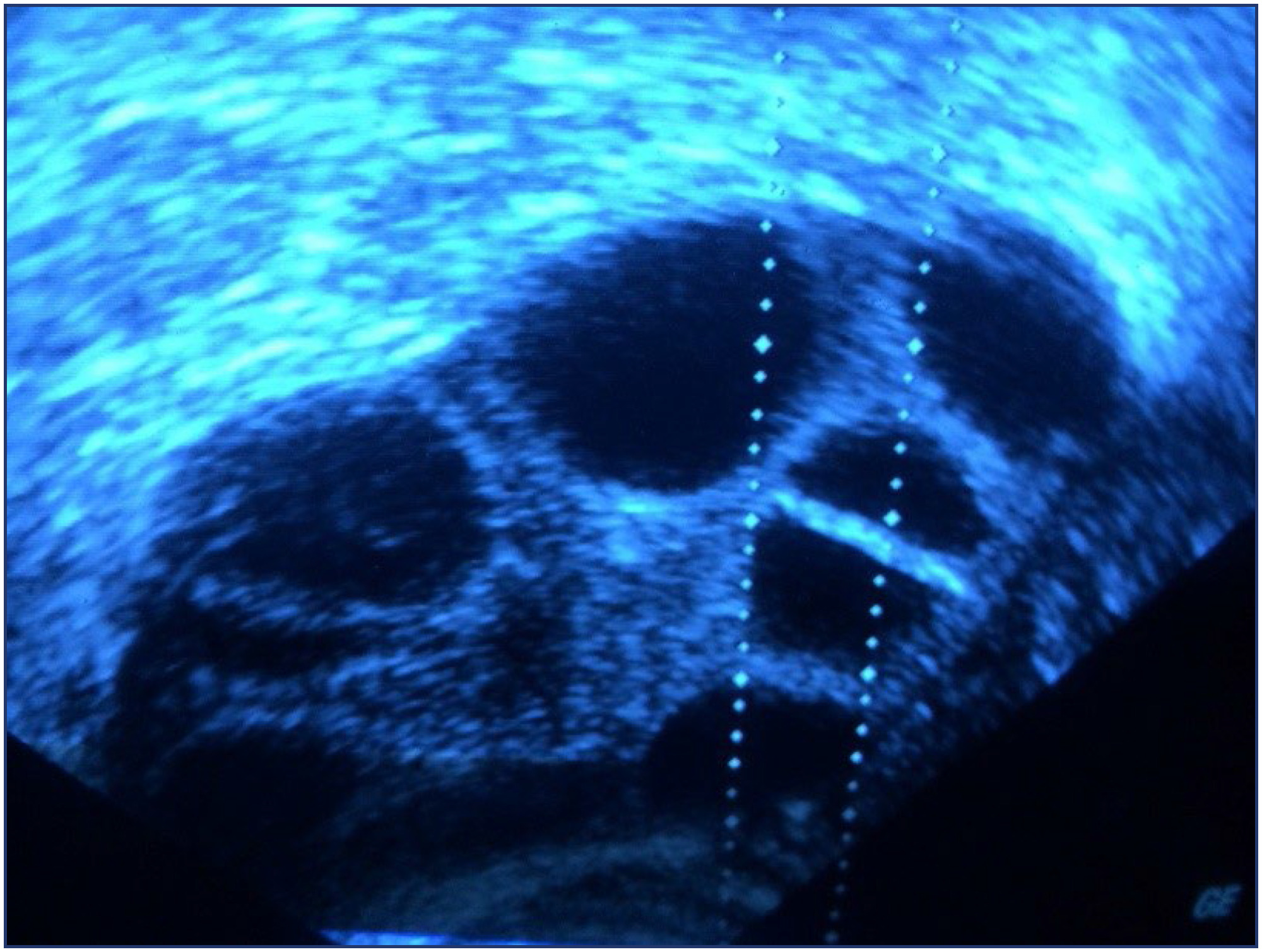 An assessment of total antioxidant and oxidant parameters and their correlation with embryo quality in in-vitro fertilization patients